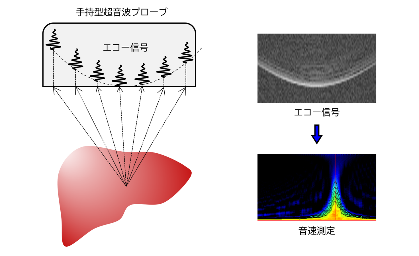 超音波を用いた組織性状評価による早期診断の図