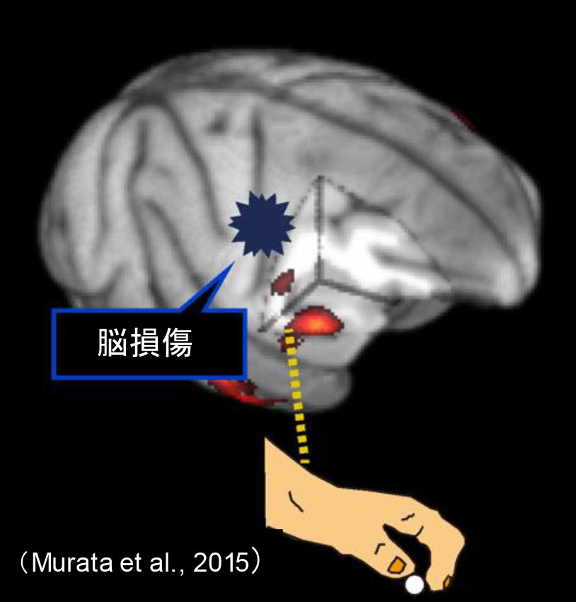 リハビリで手の運動機能が回復した時、損傷した脳の機能を脳の別の場所が果たしている図
