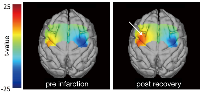 図：運動機能回復に伴う脳活動変容のfNIRSデータ